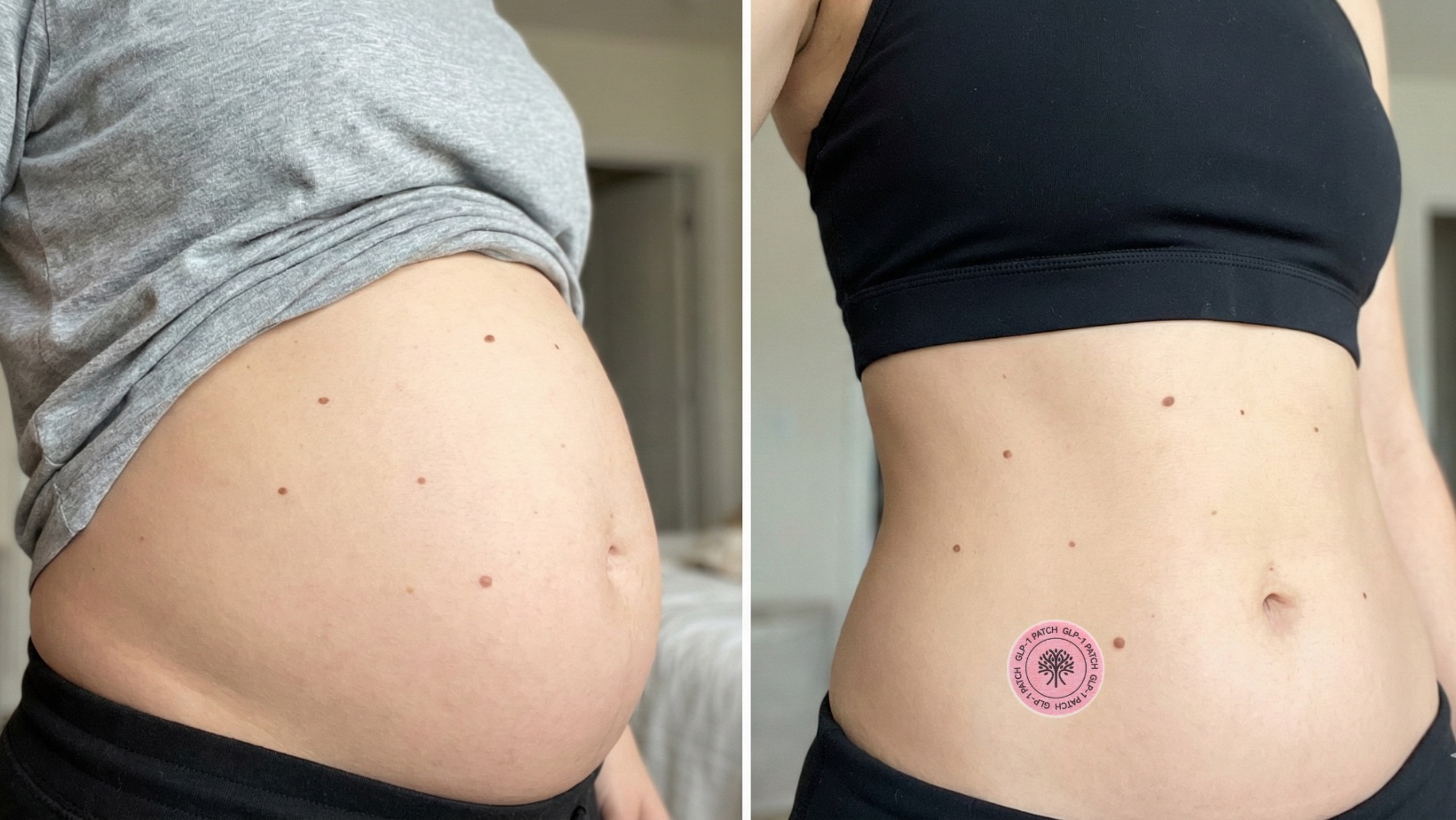 GLP-1 plāksteru lietošanas rezultāts